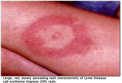 Allergic Rash From Antibiotics | LIVESTRONG.COM